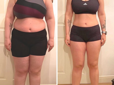 Sandra M. before and after Gumitide
